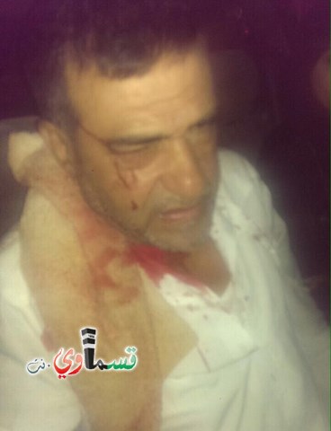 اللد : عماد أبو شرخ  مستوطنون اعتدوا عليّ بصورة وحشية